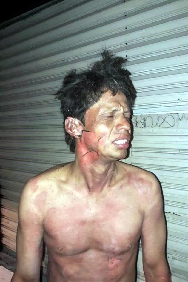 José Ramón Escobedo tuvo que ser atendido en el Hospital Rubén Leñero por las lesiones que las llamas le dejaron.