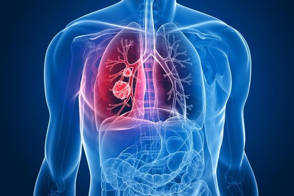 La neumonía es un proceso infeccioso de los pulmones provocado por bacterias, virus u hongos.