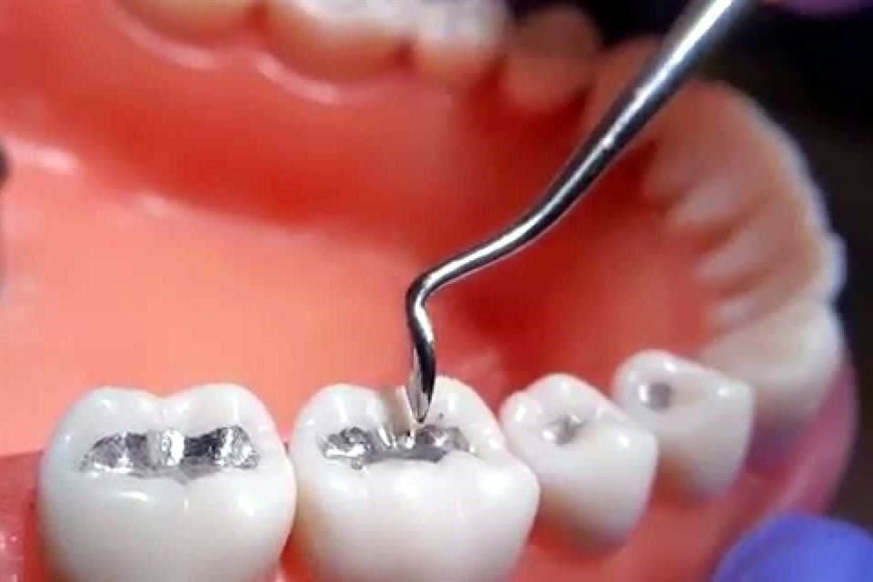 La amalgama dental consiste en una aleación de color gris metálico compuesta por una mezcla de mercurio, plata y otros metales como el estaño, cobre y zinc.