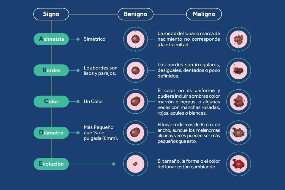 Existen algunas señales de que puede producirse el cáncer de piel tipo melanoma, aprende a identificarlas.