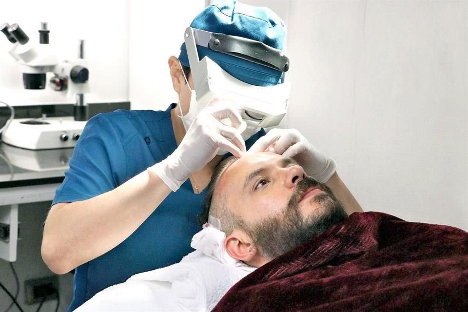 SAVANT tiene un 99% de efectividad en injertos capilares.