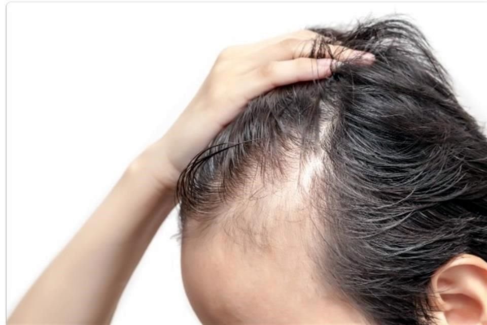 Acudir a un especialista siempre será la mejor opción para contrarrestar la alopesia.