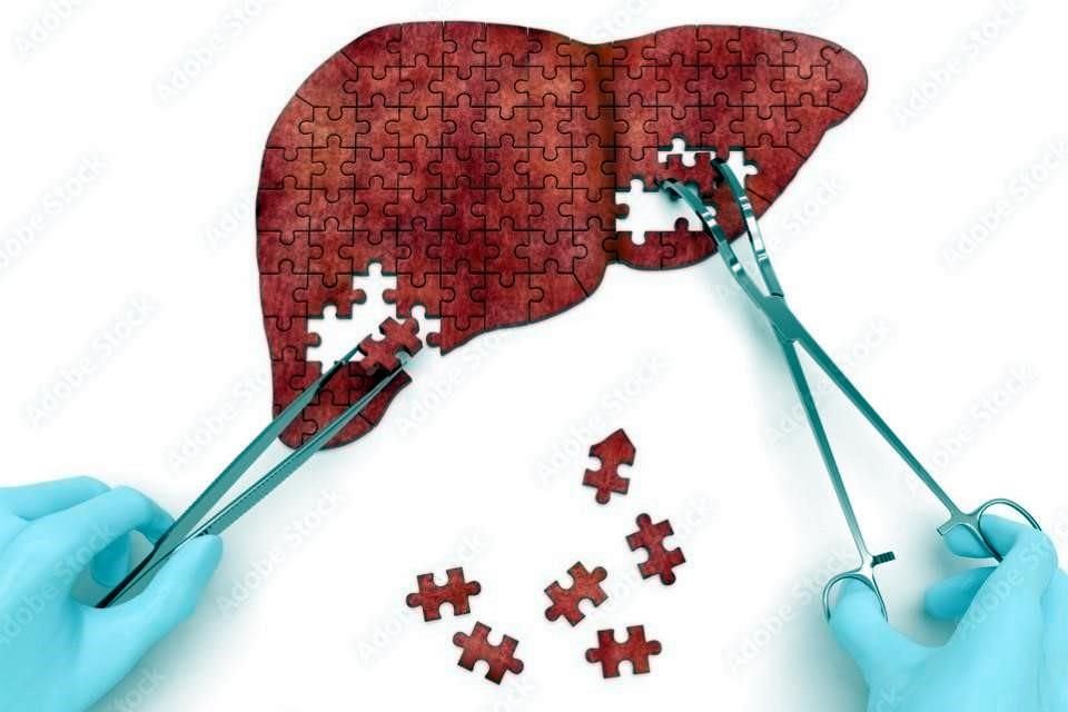 El trasplante hepático de donador vivo consiste en tomar una parte del hígado de un paciente sano para trasplantarlo a quien sufre una enfermedad hepática.