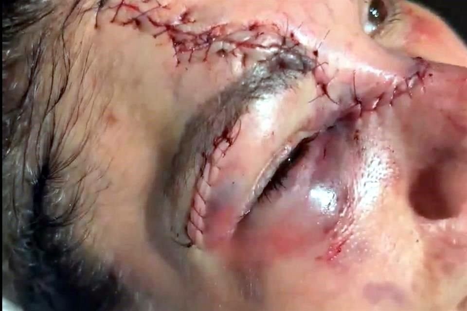 Aldana necesitó gran cantidad de puntadas para cerrar las lesiones y ahora usa algo parecido a un parche sobre la zona dañada.