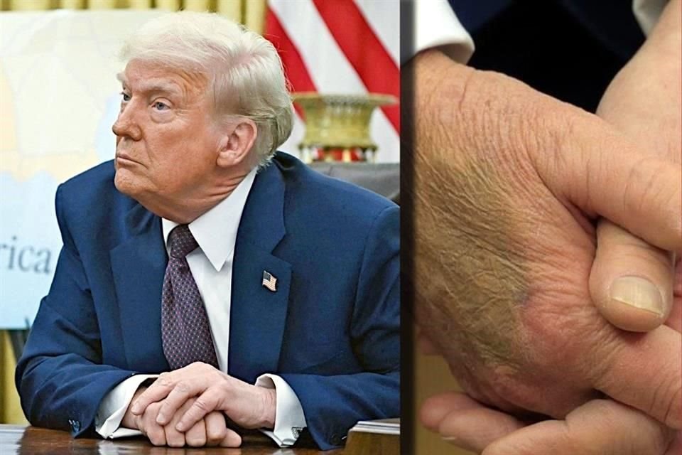 Donald Trump, Presidente de EU, llamó la atención por un moretón en el dorso de una de sus manos, presuntamente cubierto con maquillaje, el pasado 24 de febrero.