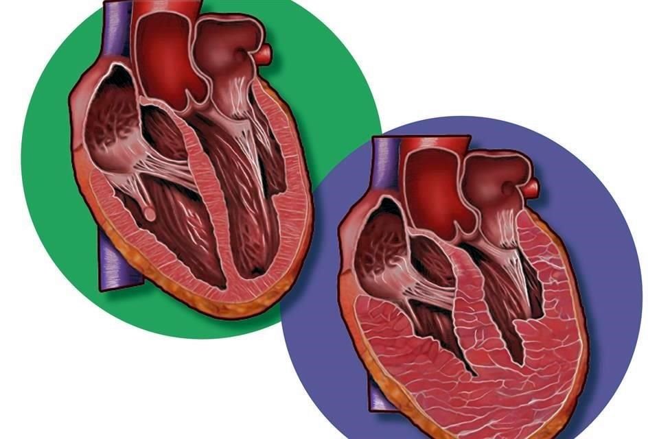 A la izquierda corte de un corazón normal; a la derecha, el órgano engrosado por miocardiopatía.