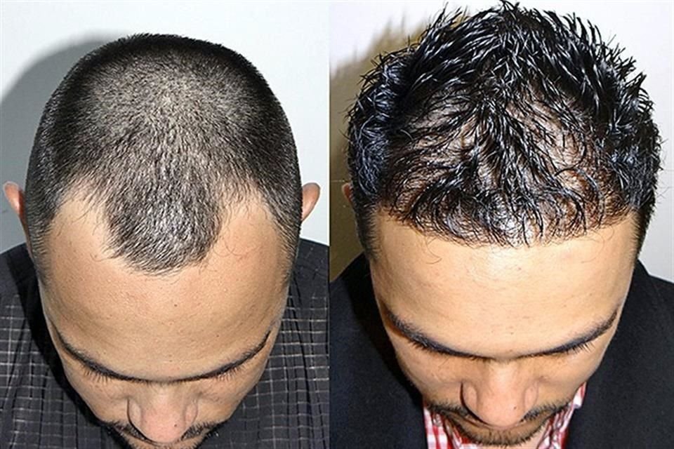 Antes y después del microinjerto.