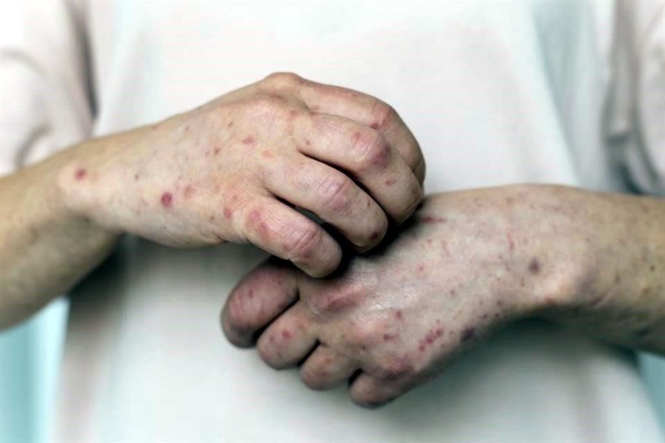 Volgens gezondheidspersoneel dat aanwezig was bij een bijeenkomst met autoriteiten die gegevens deelden, melden drie gemeenten in Mexico-Stad gevallen van mazelen.