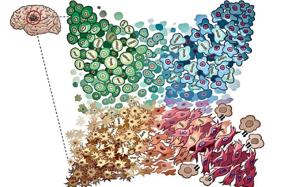 Tirosh y otros investigadores descubrieron que el tumor del glioblastoma multiforme --una forma de cáncer cerebral-- está integrado por cuatro patrones de células distintas.
