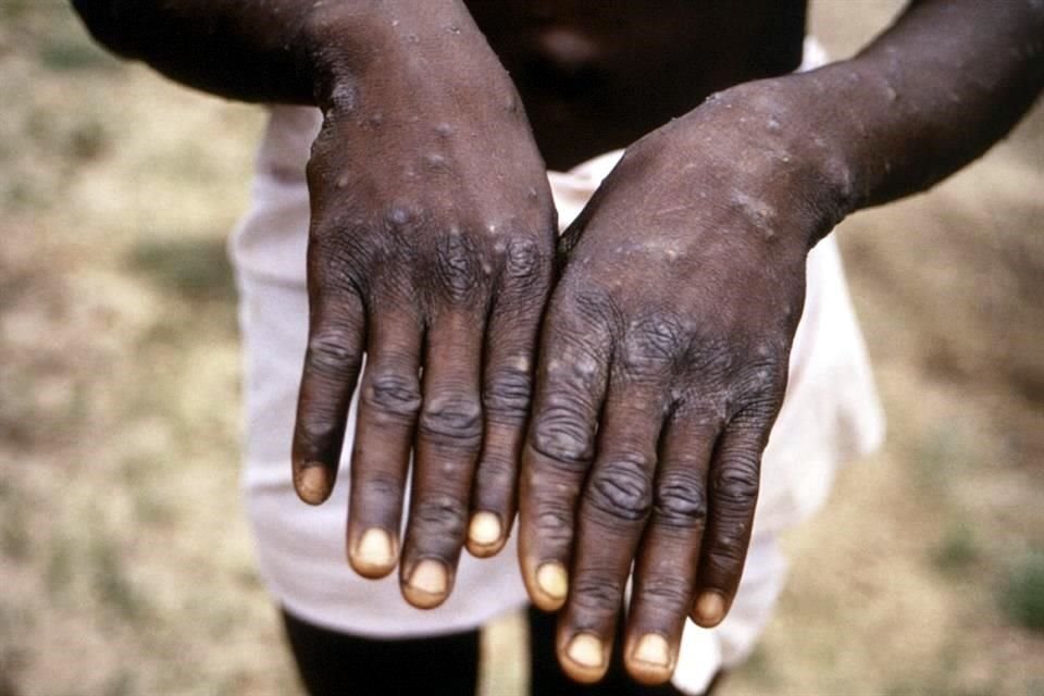 La enfermedad es endémica de África y entre sus síntomas están la presencia de pústulas en el cuerpo.