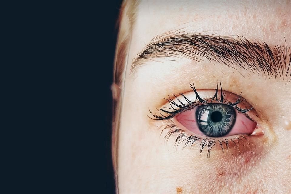 La oftalmóloga Franco explica que la persona que no se atiende un ojo rojo puede llegar a tener disminución en la calidad sensorial.